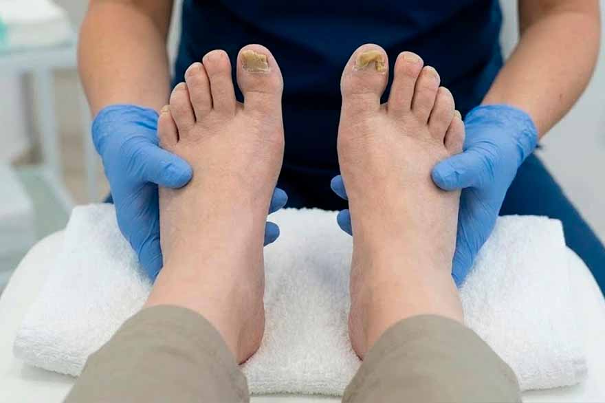 Imagen de Onicomicosis