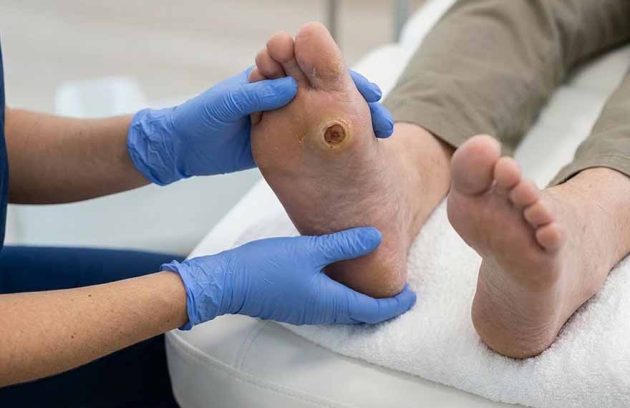 Fotografía de Úlcera Neuropática