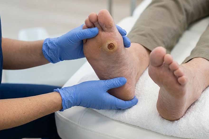 Fotografía de Úlcera Neuropática