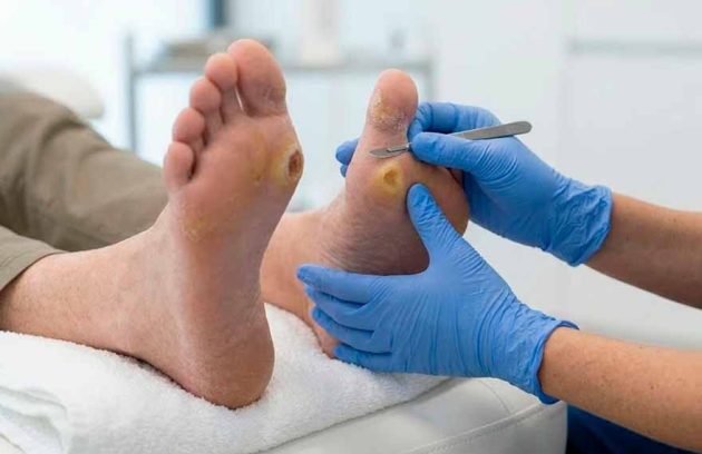 fotografía de callos