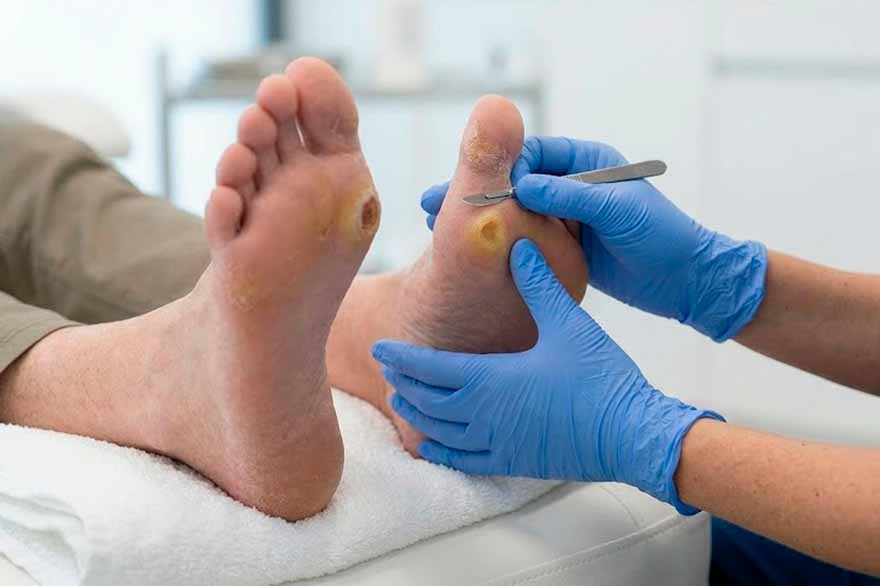 fotografía de callos